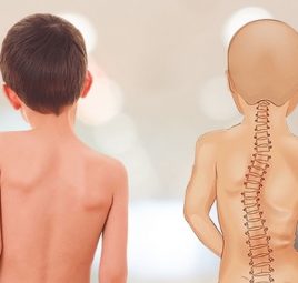 Bật mí cách ngủ ngon khi bị vẹo cột sống